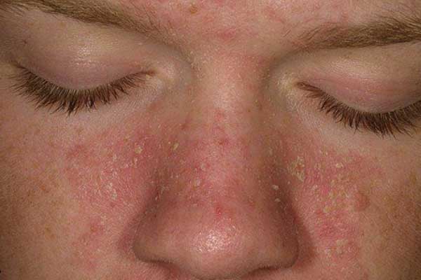 滲出性湿疹の原因は何ですか?