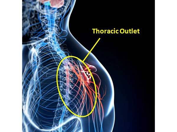 胸郭出口症候群のテスト 症状 治療 ストレッチ リハビリの全知識